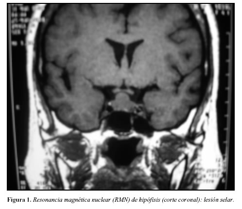  on Acta Medica Colombiana   Hypophysiary Hyperplasia Secondary To Primary