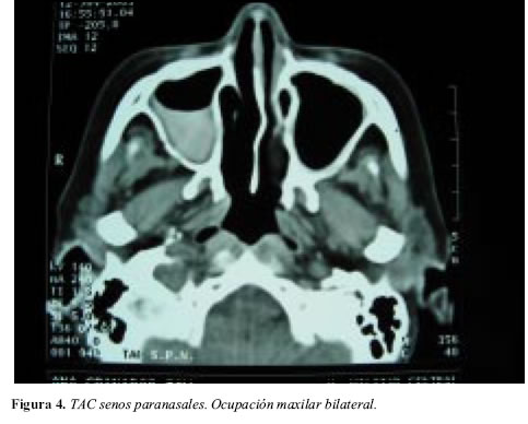  on Acta Medica Colombiana   Ch  Rg Strauss Syndrome