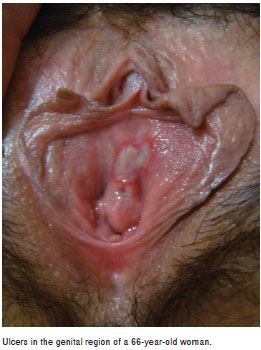 Genital ulcer - RightDiagnosis.com