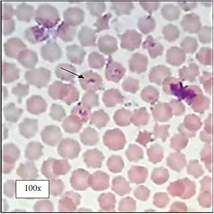 Babesia bigemina en bovinos del municipio Los Palmitos (Sucre, Colombia)
