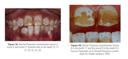 difference between tooth decay stain