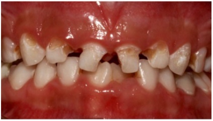 composite restoration deciduous teeth