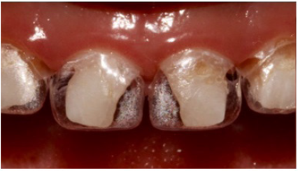 composite restoration deciduous teeth