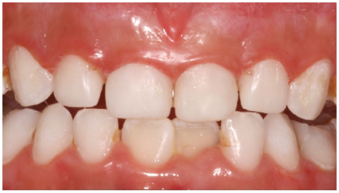 composite restoration deciduous teeth
