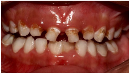 Aesthetic Rehabilitation With Strip Crowns In Pediatric Dentistry A aesthetic-rehabilitation-with-strip-crowns-in-pediatric-dentistry-a