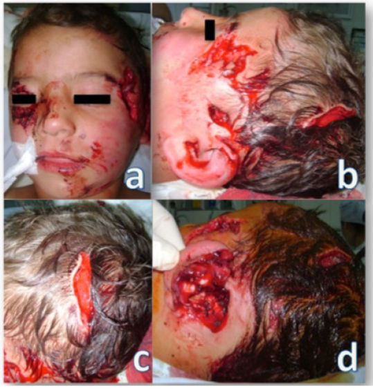 Maxillofacial management of dog bites injuries in an infant: A case report