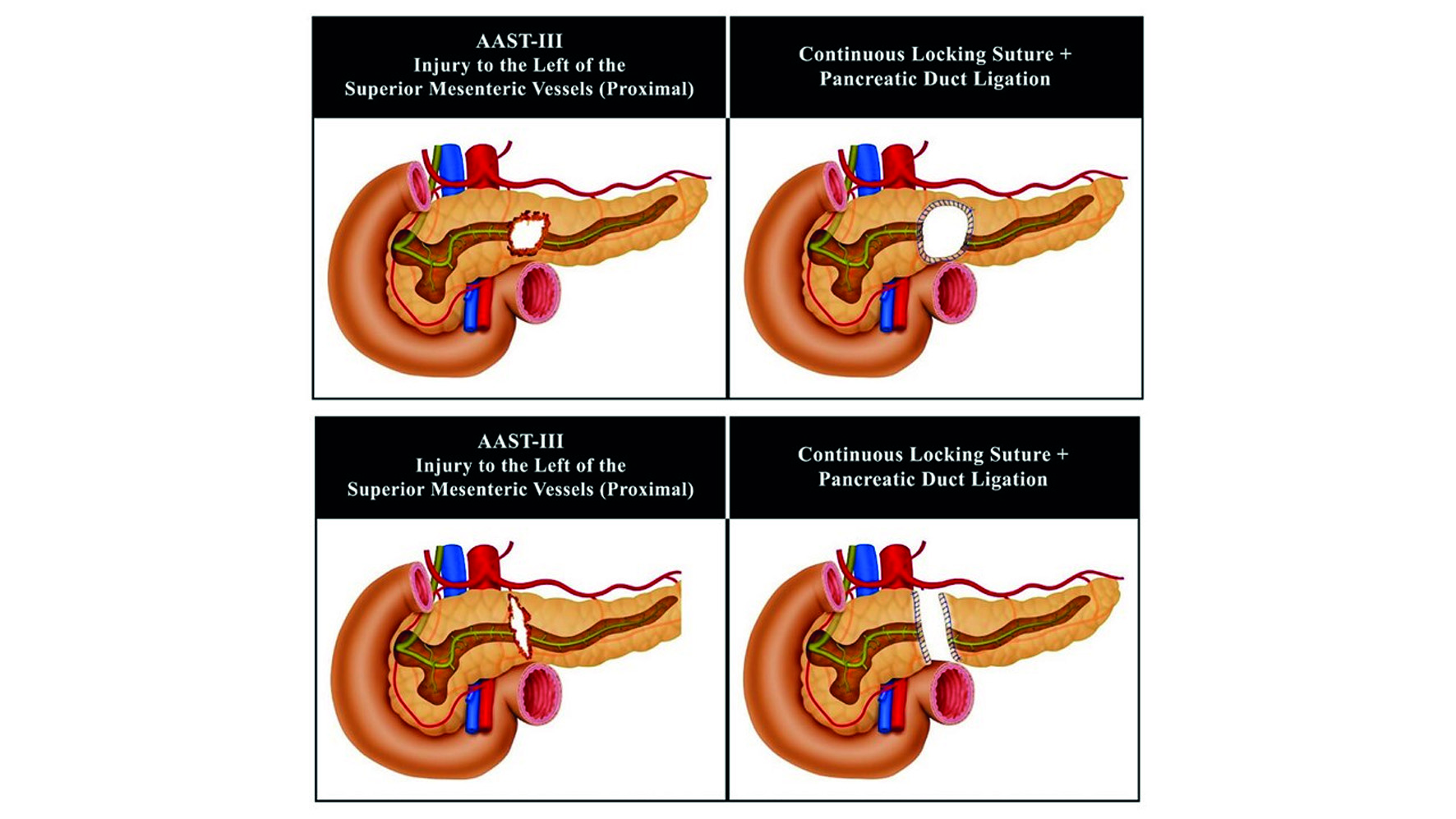 Pancreatic trauma