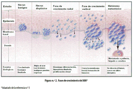 Malignant Melanoma Picture Image on MedicineNet.com