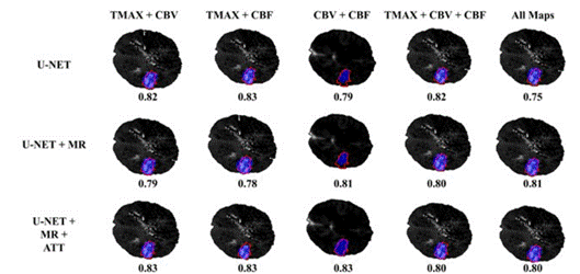 A Deep Cascade Architecture for Stroke Lesion Segmentation and ...