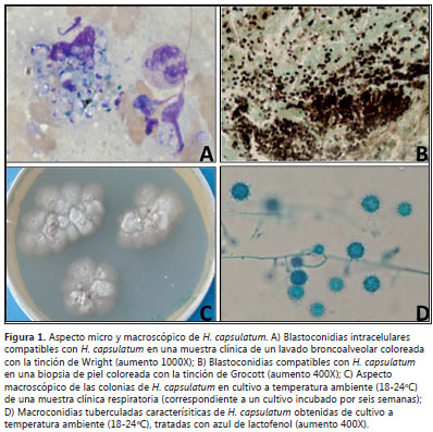 Blastomicosis Pulmonar Pdf