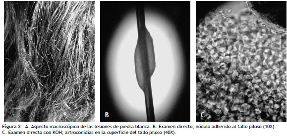 Piedra negra y piedra blanca: aspectos diferenciales