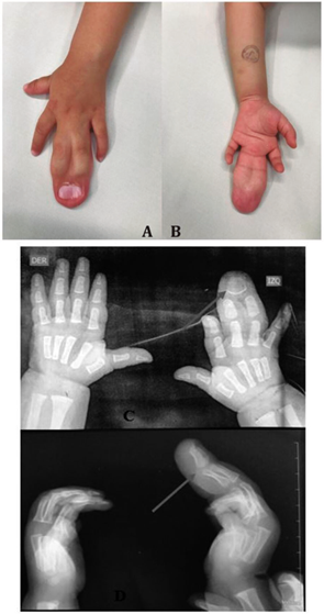 Medidas de clavos con el sistema de dedos de la mano 