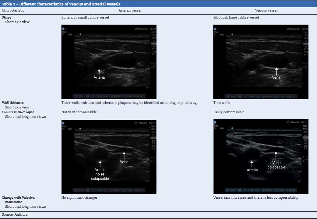 subclavian vein cannulation pdf