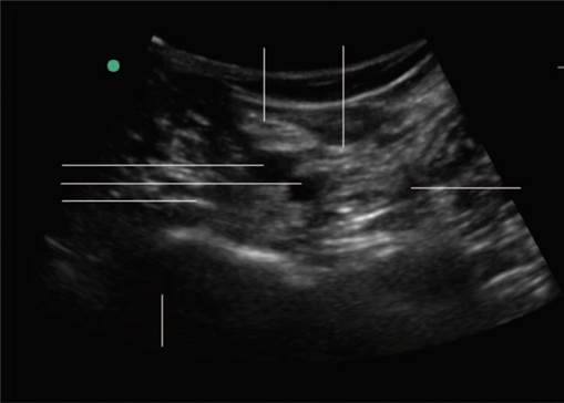 ipack block ultrasound ipack block ultrasound