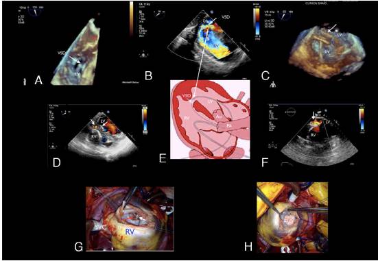 Percutaneous device closure of ventricular septal defect post-acute ...