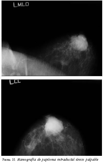 Il papilloma virus guarisce da solo. Papilloma seno b2