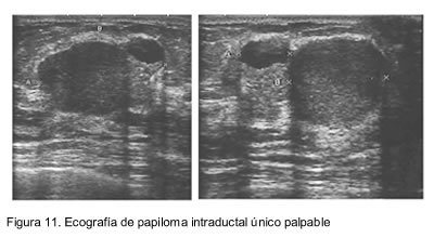 que es papiloma intraductal de mama)