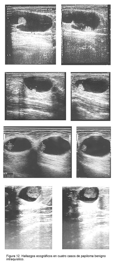 Papilloma intraduttale multiplo Sospetto papilloma intraduttale