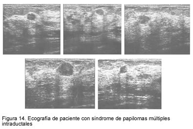 Multiple intraductal papillomatosis - Romanian Journal of Anatomy