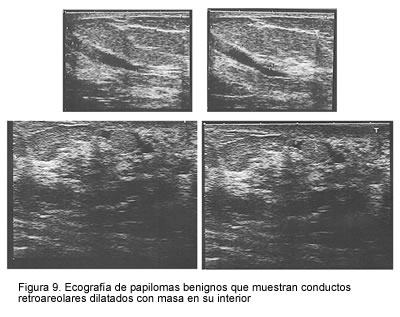 papiloma intraductal en el seno