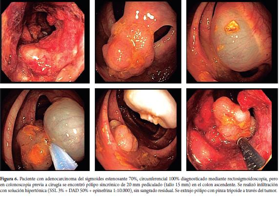 rectal polypectomy