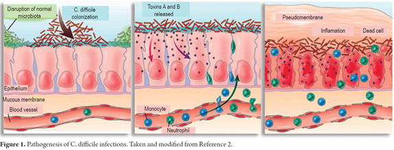 Imagen de la invasión de Clostridium difficile en el intestino