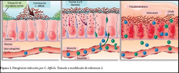 Clostridium difficile - toxina A & B - Detalii analiza | Bioclinica