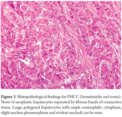 cancer hepatic fibrolamelar