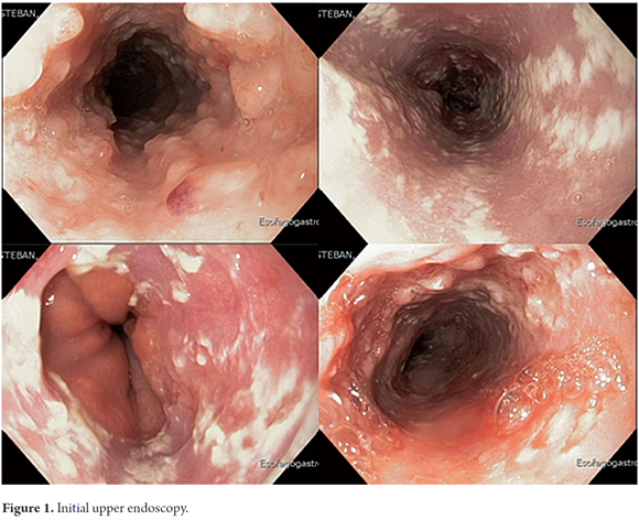 Para que se hace una endoscopia digestiva alta