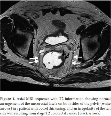 Rectal cancer in mri, Rectal cancer and colon cancer, REVIEW-URI