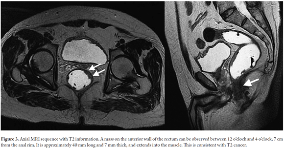 rectal cancer on ct)