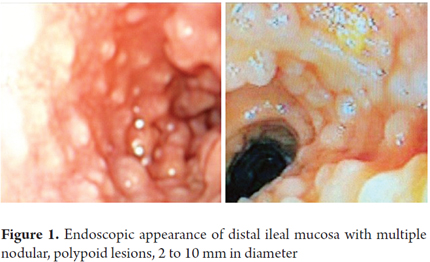 giardiasis endoscopy)