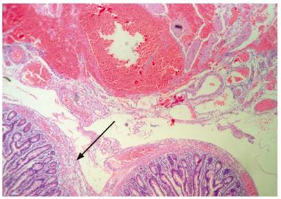 diverticulosis-histology-685x483