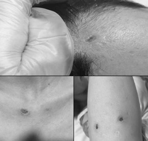 Trastorno De Excoriaci n En Una Mujer Con Panarteritis Nudosa Reporte 