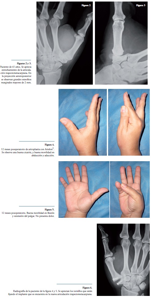 Rizartrosis o artrosis del pulgar - Signos radiológicos