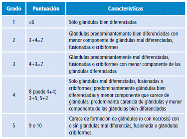 adenocarcinoma prostate gleason 33