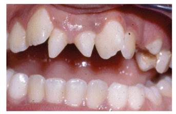 delayed eruption of permanent teeth treatment