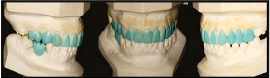 ODONTO-ESTOMATOLOGICA: SECUENCIA DE PRUEBAS EN CONSULTA PARA CONFECCION DE CORONA  METAL-CERÁMICA EN PORCELANA