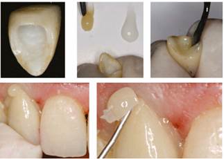 ODONTO-ESTOMATOLOGICA: SECUENCIA DE PRUEBAS EN CONSULTA PARA CONFECCION DE CORONA  METAL-CERÁMICA EN PORCELANA