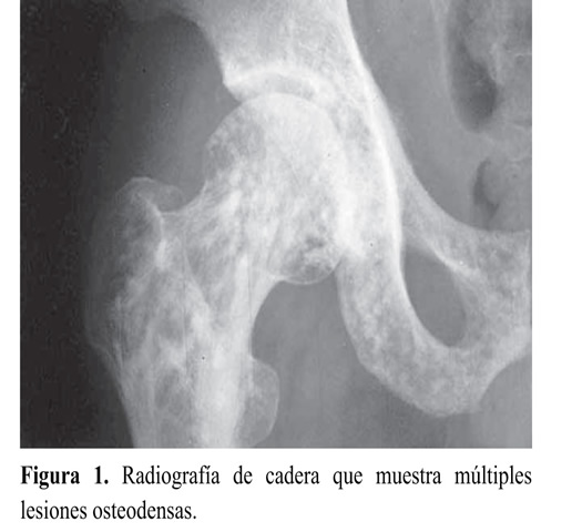 kenőcsök a vállízület osteochondrosisához)