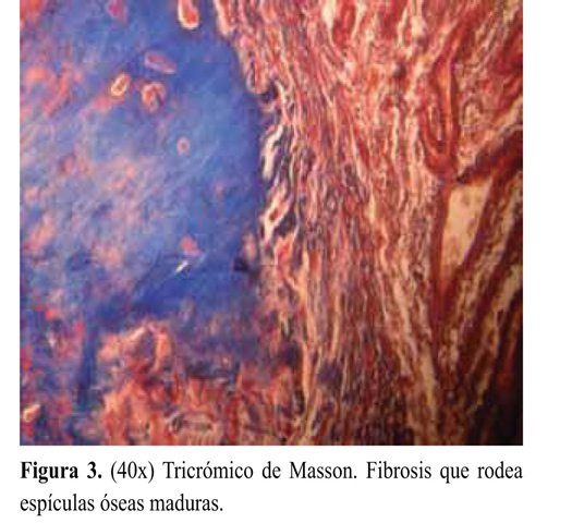 Milyen kenőcsöt használnak az osteochondrosishoz, Lumbalis osteochondrosis kenőcs